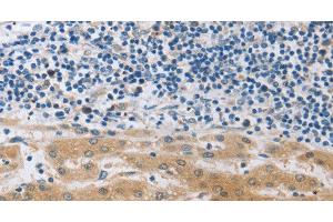 Immunohistochemistry of paraffin-embedded Human liver cancer using MUC20 Polyclonal Antibody at dilution of 1:40