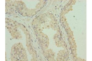 Immunohistochemistry of paraffin-embedded human prostate cancer using ABIN7146065 at dilution of 1:100 (CLEC3A Antikörper  (AA 23-197))