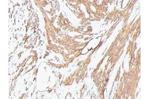 Formalin-fixed, paraffin-embedded human leiomyosarcoma stained with pan Muscle Actin antibody (Pan Muscle Actin Antikörper)