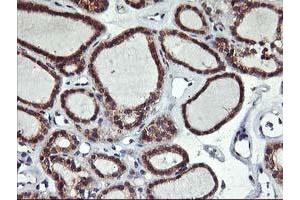 Immunohistochemical staining of paraffin-embedded Carcinoma of Human thyroid tissue using anti-ALG2 mouse monoclonal antibody. (ALG2 Antikörper)