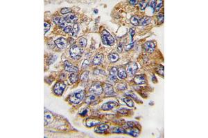 Formalin-fixed and paraffin-embedded human lung carcinoma tissue reacted with GRB2 Antibody , which was peroxidase-conjugated to the secondary antibody, followed by DAB staining. (GRB2 Antikörper  (AA 187-216))