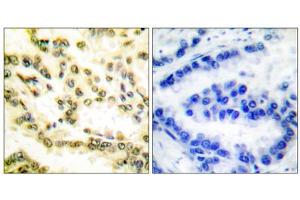 Immunohistochemical analysis of paraffin-embedded human lung carcinoma tissue, using Lamin A (cleaved-Asp230) antibody. (Lamin A/C Antikörper  (Cleaved-Asp230, Internal Region))
