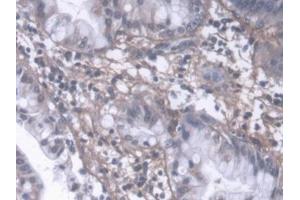 DAB staining on IHC-P; Samples: Human Liver cancer Tissue (PIIINP Antikörper  (AA 24-153))