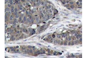 Immunohistochemistry analysis of NFκB-p105/p50 antibody in paraffin-embedded human breast carcinoma tissue. (NFKB1 Antikörper)