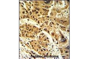 Formalin-fixed and paraffin-embedded human hepatocarcinoma with LPIN2 Antibody (Center), which was peroxidase-conjugated to the secondary antibody, followed by DAB staining. (Lipin 2 Antikörper  (AA 262-288))