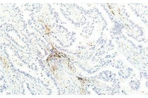 Immunohistochemistry of paraffin-embedded Human lung carcinoma tissue using JAK1 Monoclonal Antibody at dilution of 1:200. (JAK1 Antikörper)
