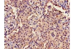 Immunohistochemistry of paraffin-embedded human lung cancer using ABIN7163589 at dilution of 1:100 (CD42a Antikörper  (AA 17-88))