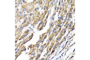 Immunohistochemistry of paraffin-embedded human liver cancer using IKBKAP Rabbit pAb (ABIN6130369, ABIN6142278, ABIN6142279 and ABIN6214265) at dilution of 1:100 (40x lens). (IKAP/p150 Antikörper  (AA 1093-1332))