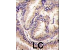 Formalin-fixed and paraffin-embedded human lung carcinoma tissue reacted with STK9 Antibody (C-term) (ABIN391362 and ABIN2841381) , which was peroxidase-conjugated to the secondary antibody, followed by DAB staining. (CDKL5 Antikörper  (C-Term))