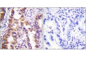 Immunohistochemistry analysis of paraffin-embedded human lung carcinoma tissue, using Tuberin/TSC2 (Ab-939) Antibody. (Tuberin Antikörper  (AA 905-954))