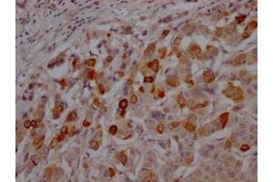 IHC image of  diluted at 1:100 and staining in paraffin-embedded human breast cancer performed on a Leica BondTM system.