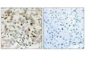 Immunohistochemistry analysis of paraffin-embedded human breast carcinoma tissue using CGREF1 antibody. (CGREF1 Antikörper  (C-Term))
