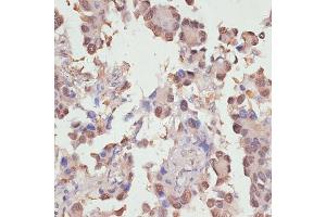Immunohistochemistry of paraffin-embedded human lung cancer using Y antibody (ABIN6132789, ABIN6150317, ABIN6150322 and ABIN6215136) at dilution of 1:100 (40x lens). (YAP1 Antikörper  (AA 155-504))