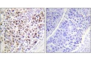 Immunohistochemistry analysis of paraffin-embedded human liver carcinoma, using AurB (Phospho-Thr232) Antibody. (Aurora Kinase B Antikörper  (pThr232))