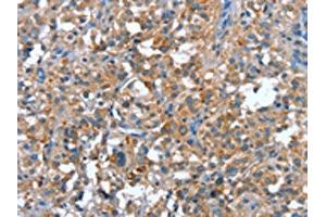 The image on the left is immunohistochemistry of paraffin-embedded Human thyroid cancer tissue using ABIN7191907(PLA2G6 Antibody) at dilution 1/15, on the right is treated with synthetic peptide. (PLA2G6 Antikörper)