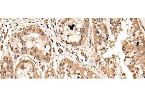 Immunohistochemistry of paraffin-embedded Human liver cancer tissue using ATAD3A Polyclonal Antibody at dilution of 1:40(x200) (ATAD3A Antikörper)