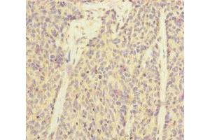 Immunohistochemistry of paraffin-embedded human ovarian cancer using ABIN7170910 at dilution of 1:100 (SUCLA2 Antikörper  (AA 1-180))