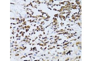 Immunohistochemistry of paraffin-embedded Human lung cancer using PIKFYVE Polyclonal Antibody at dilution of 1:100 (40x lens).