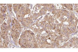 ABIN6276463 at 1/100 staining Human Melanoma tissue by IHC-P. (Endothelin 3 Antikörper  (C-Term))
