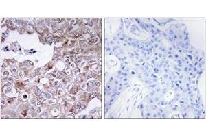 Immunohistochemistry analysis of paraffin-embedded human breast carcinoma tissue, using MUC1 Antibody.