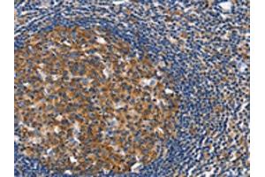 The image on the left is immunohistochemistry of paraffin-embedded Human tonsil tissue using ABIN7128916(CEP97 Antibody) at dilution 1/40, on the right is treated with fusion protein. (CEP97 Antikörper)