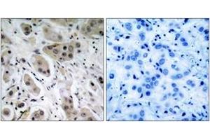 Immunohistochemistry analysis of paraffin-embedded human breast carcinoma, using Akt (Phospho-Ser473) Antibody. (AKT1 Antikörper  (pSer473))