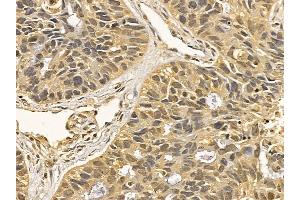 HSP70 Mouse Monoclonal Antibody at 1/100 staining human lung cancer and adjacent non-tumor tissue by IHC-P. (HSP70 Antikörper  (C-Term))