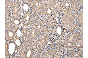The image on the left is immunohistochemistry of paraffin-embedded Human thyroid cancer tissue using ABIN7128011(SERPINA7 Antibody) at dilution 1/25, on the right is treated with fusion protein. (SERPINA7 Antikörper)