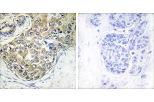 Immunohistochemistry analysis of paraffin-embedded human breast carcinoma tissue using ACK1 (Phospho-Tyr284) antibody. (TNK2 Antikörper  (pTyr284))