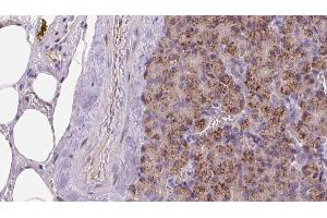 ABIN6273259 at 1/100 staining Human pancreas cancer tissue by IHC-P. (KIDINS220 Antikörper  (Internal Region))