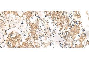 Immunohistochemistry of paraffin-embedded Human lung cancer tissue using HNF1A Polyclonal Antibody at dilution of 1:25(x200) (HNF1A Antikörper)