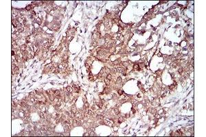 Immunohistochemical analysis of paraffin-embedded cervical cancer tissues using MMEL1 mouse mAb with DAB staining. (MMEL1 Antikörper  (AA 1-107))