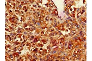 Immunohistochemistry of paraffin-embedded human melanoma using ABIN7146559 at dilution of 1:100 (CNN3 Antikörper  (AA 2-329))