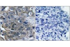 Immunohistochemistry analysis of paraffin-embedded human breast carcinoma tissue, using HER2 (Ab-877) Antibody. (ErbB2/Her2 Antikörper  (AA 851-900))