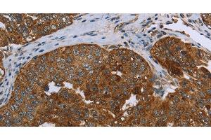 Immunohistochemistry of paraffin-embedded Human ovarian cancer using SNCG Polyclonal Antibody at dilution of 1:60 (SNCG Antikörper)