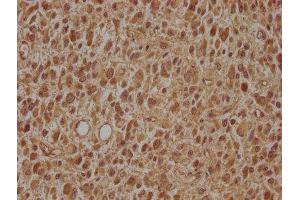 IHC image of ABIN7143497 diluted at 1:100 and staining in paraffin-embedded human glioma cancer performed on a Leica BondTM system. (ARL2BP Antikörper  (AA 1-163))