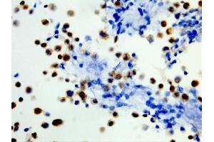 ICC staining of formalin fixed and paraffin embedded human WiDr cells (400X, Positive) with recombinant BRAF V600E antibody. (Rekombinanter BRAF Antikörper  (Val600Glu-Mutant))