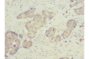 Immunohistochemistry of paraffin-embedded human gastric cancer using ABIN7158529 at dilution of 1:100 (ACSBG2 Antikörper  (AA 301-600))