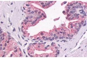 Immunohistochemical (Formalin/PFA-fixed paraffin-embedded sections) staining in human prostate, epithelium with GPR87 polyclonal antibody . (GPR87 Antikörper  (Extracellular Domain))