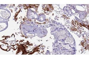 ABIN6273442 at 1/100 staining Human urothelial cancer tissue by IHC-P.