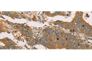 Immunohistochemistry of paraffin-embedded Human gastric cancer tissue using XPR1 Polyclonal Antibody at dilution of 1:45(x200) (xpr1 Antikörper)