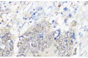 Immunohistochemistry of paraffin-embedded Human colon carcinoma using GPX2 Polyclonal Antibody at dilution of 1:100 (40x lens). (Glutathione Peroxidase 2 Antikörper)