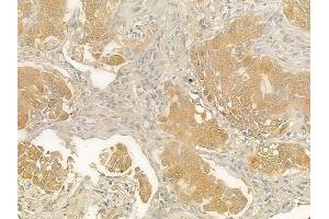 ABIN6263074 and ABIN6278147 at 1/100 staining human lung squamous cell carcinoma by IHC-P. (Melanoma Antigen Family D, 4 (MAGED4) (N-Term) Antikörper)