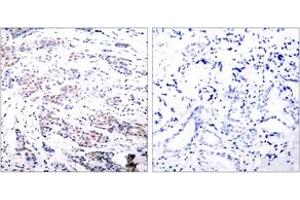 Immunohistochemistry analysis of paraffin-embedded human breast carcinoma tissue, using Elk1 (Ab-383) Antibody.