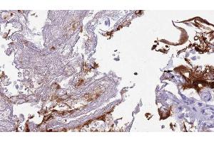 ABIN6273445 at 1/100 staining Human urothelial cancer tissue by IHC-P. (CD27 Antikörper  (Internal Region))