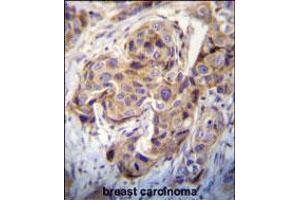DUSP3 Antibody immunohistochemistry analysis in formalin fixed and paraffin embedded human breast carcinoma followed by peroxidase conjugation of the secondary antibody and DAB staining.