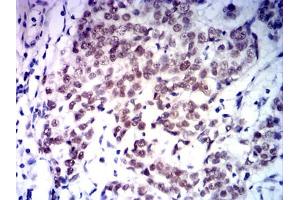 Immunohistochemical analysis of paraffin-embedded bladder cancer tissues using MLH1 mouse mAb with DAB staining. (MLH1 Antikörper  (AA 381-483))
