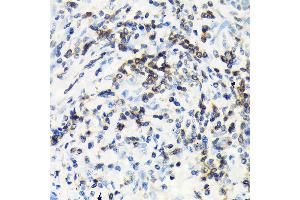 Immunohistochemistry of paraffin-embedded human lung cancer using CSK Rabbit mAb (ABIN1513217, ABIN3021034, ABIN3021035 and ABIN7101334) at dilution of 1:100 (40x lens). (CSK Antikörper)