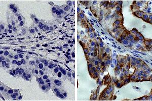 Paraffin embedded human gastric cancer tissue was stained with Mouse IgG2a-HRP isotype control followed by DAB and hematoxylin. (KRT8 Antikörper  (HRP))