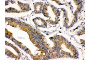 IHC(P): Human Intestinal Cancer Tissue (BMP2 Antikörper  (C-Term))
